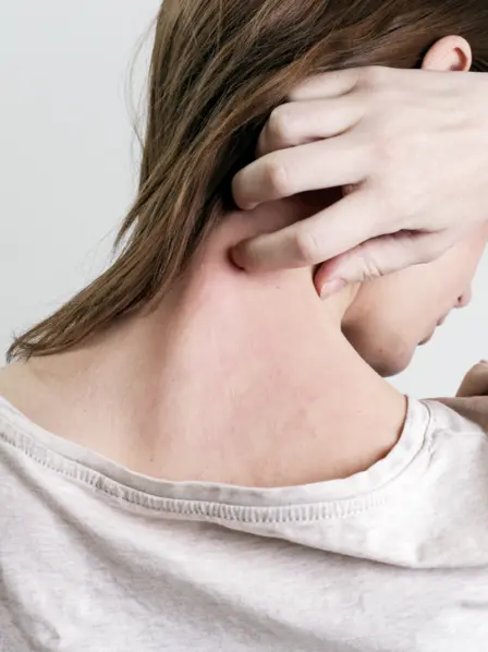 Frau kratzt ihren geröteten Nacken.