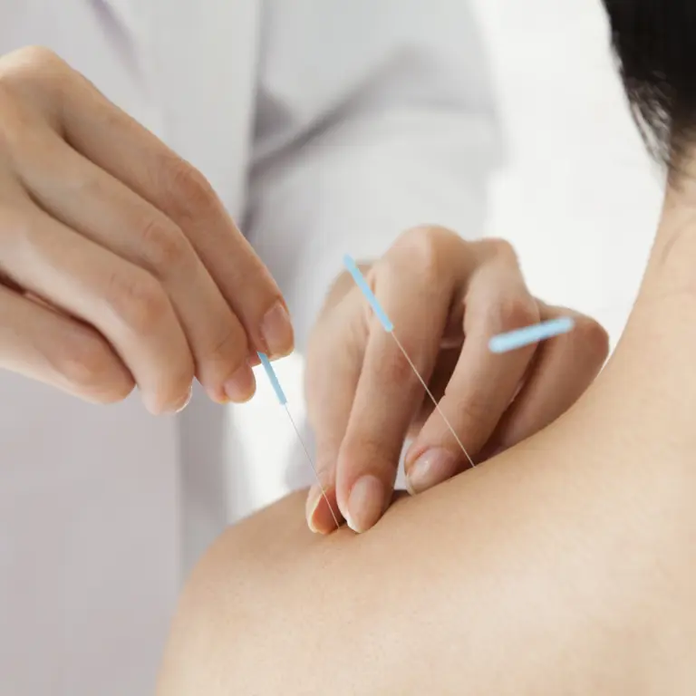 Patientin bekommt Akupunkturnadeln in den Schulter-Nacken-Bereich gesetzt