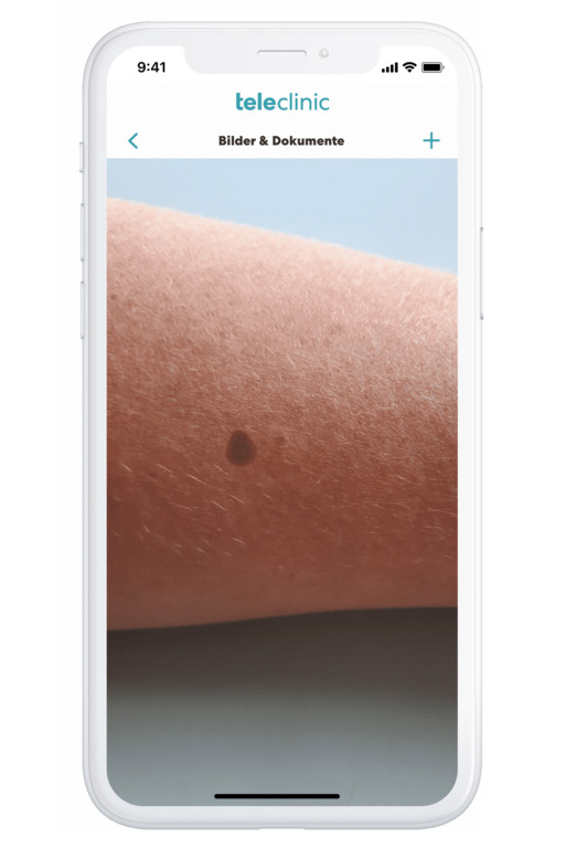 hochgeladenes Bild eines Muttermals in der TeleClinic-App